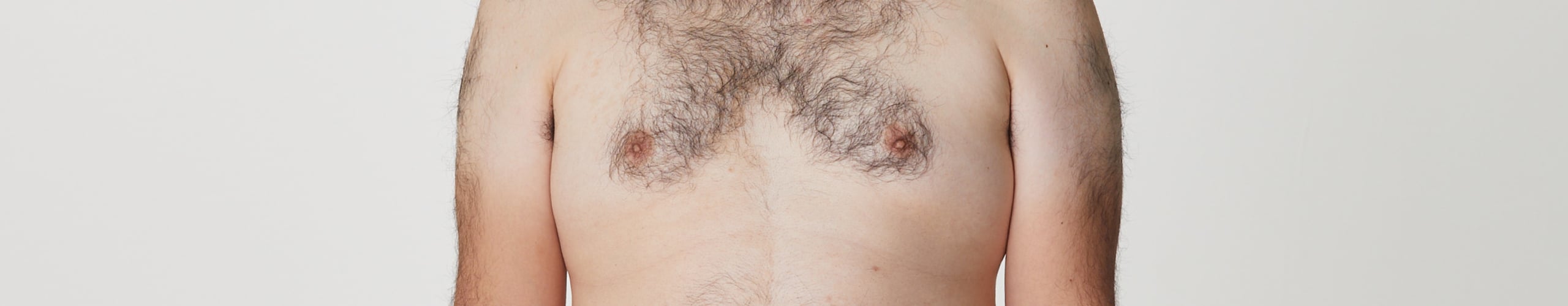 全身脱毛の症例一覧