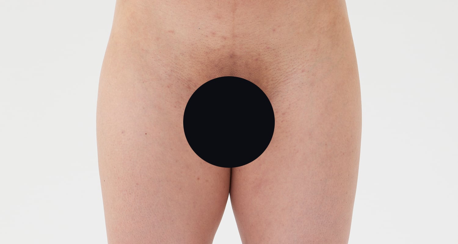 VIO脱毛の症例一覧