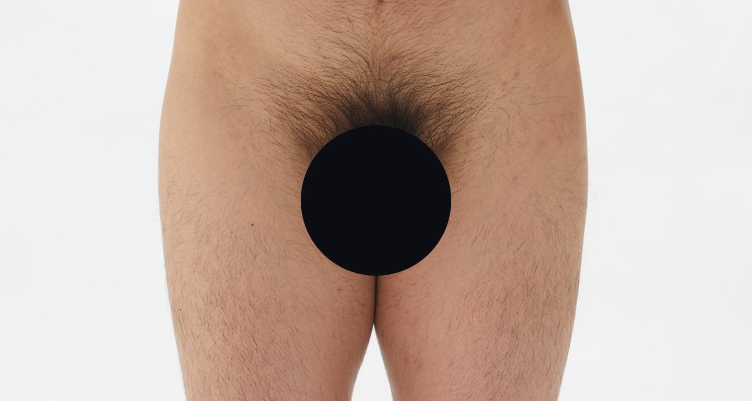 VIO脱毛の症例一覧