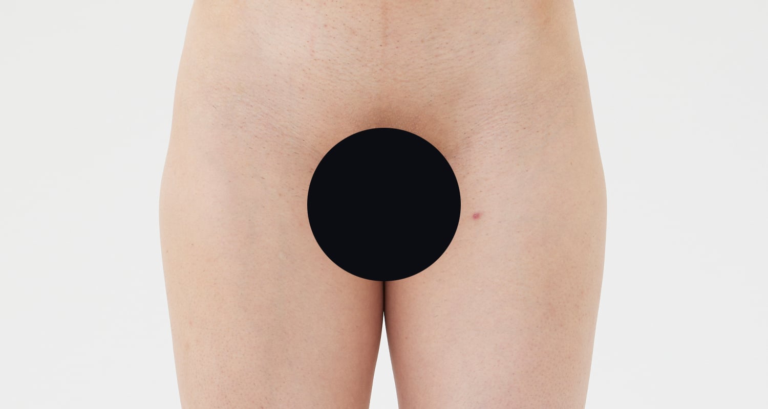 VIO脱毛の症例一覧