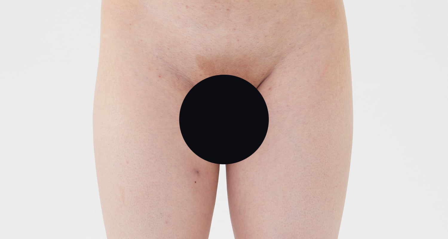 VIO脱毛の症例一覧