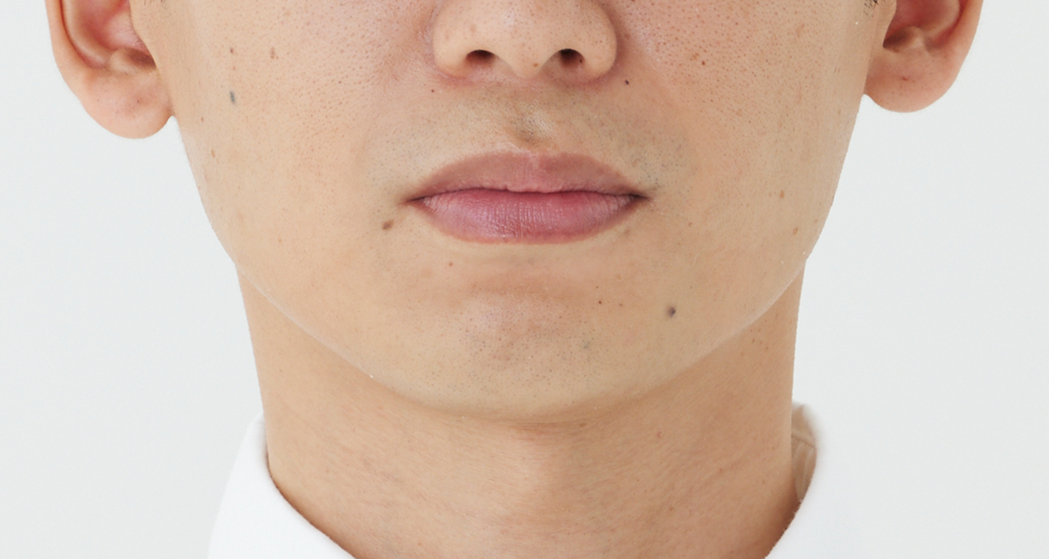 ヒゲ脱毛の症例写真 鼻下・あご 10回照射後