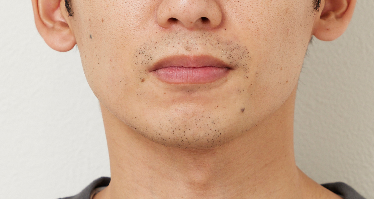 ヒゲ脱毛の症例写真 鼻下・あご 3回照射後