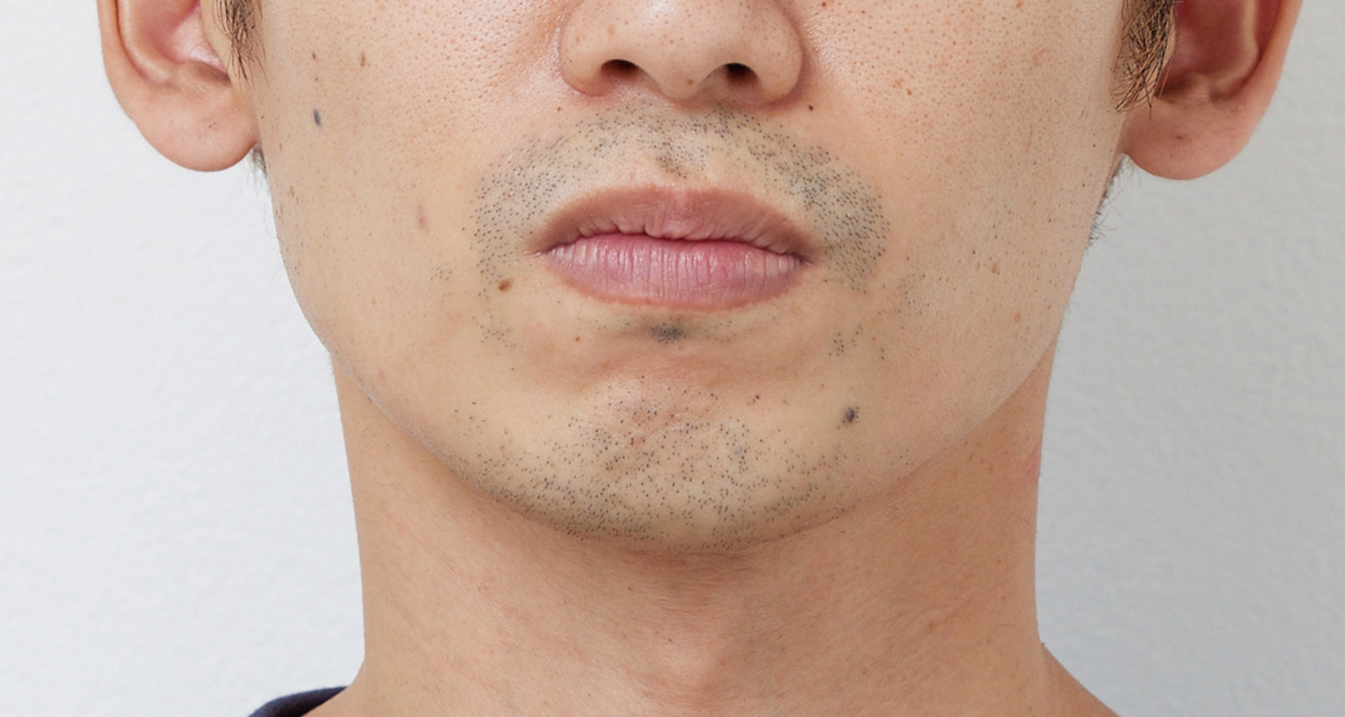 ヒゲ脱毛の症例写真 鼻下・あご 4回照射後