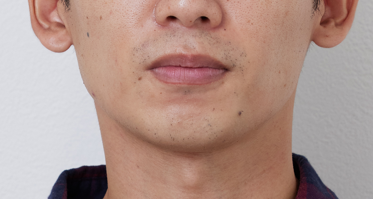 ヒゲ脱毛の症例写真 鼻下・あご 5回照射後