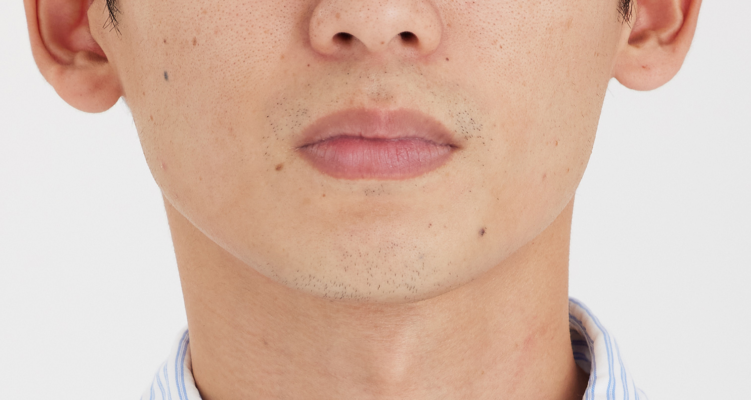 ヒゲ脱毛の症例写真 鼻下・あご 6回照射後