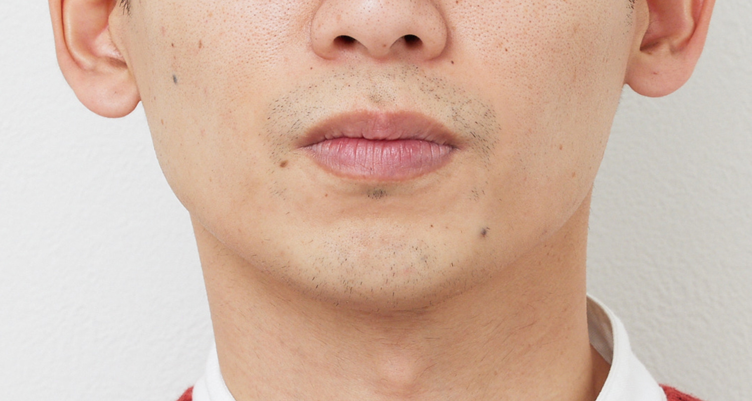 ヒゲ脱毛の症例写真 鼻下・あご 7回照射後