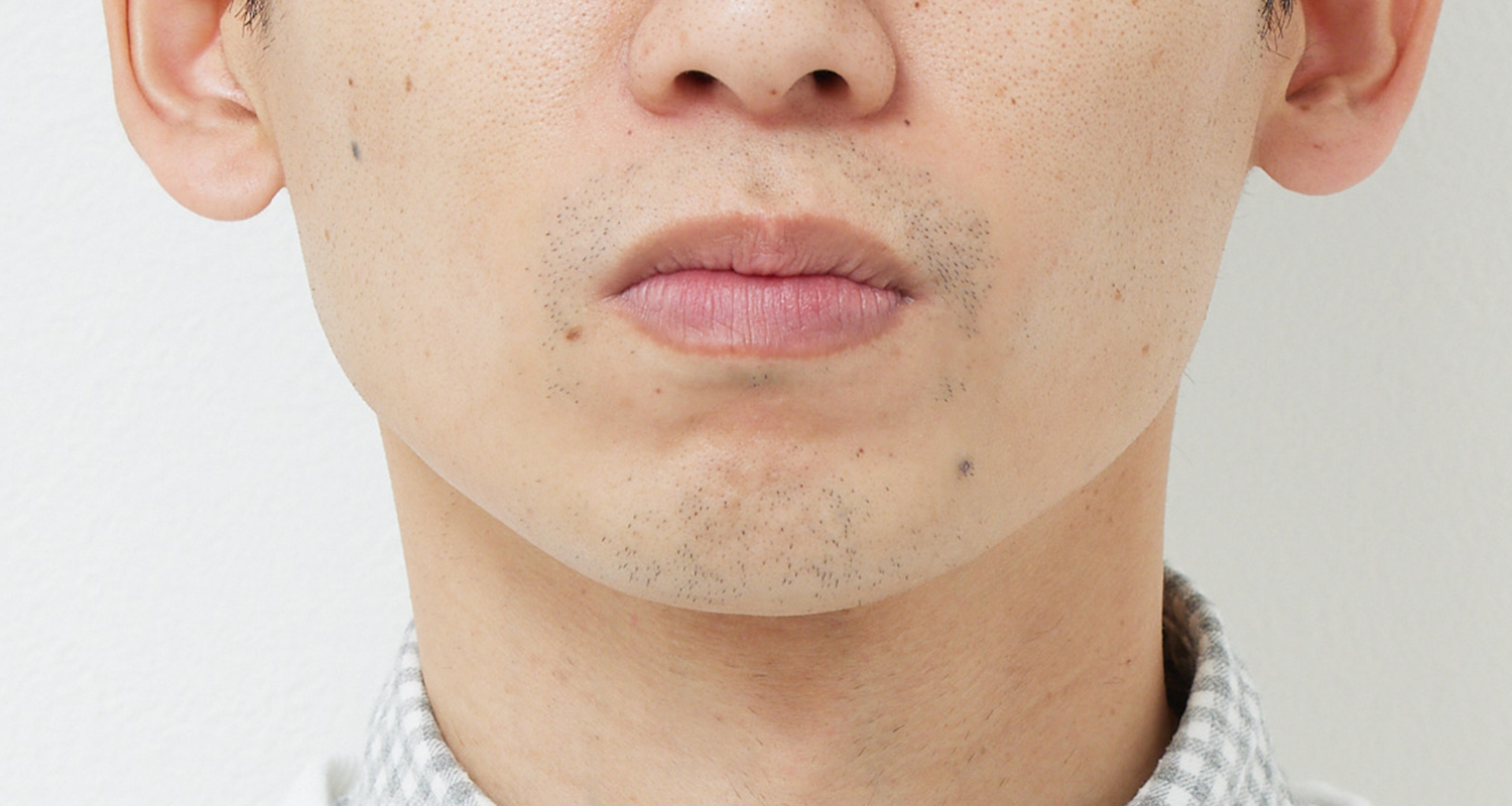 ヒゲ脱毛の症例写真 鼻下・あご 8回照射後