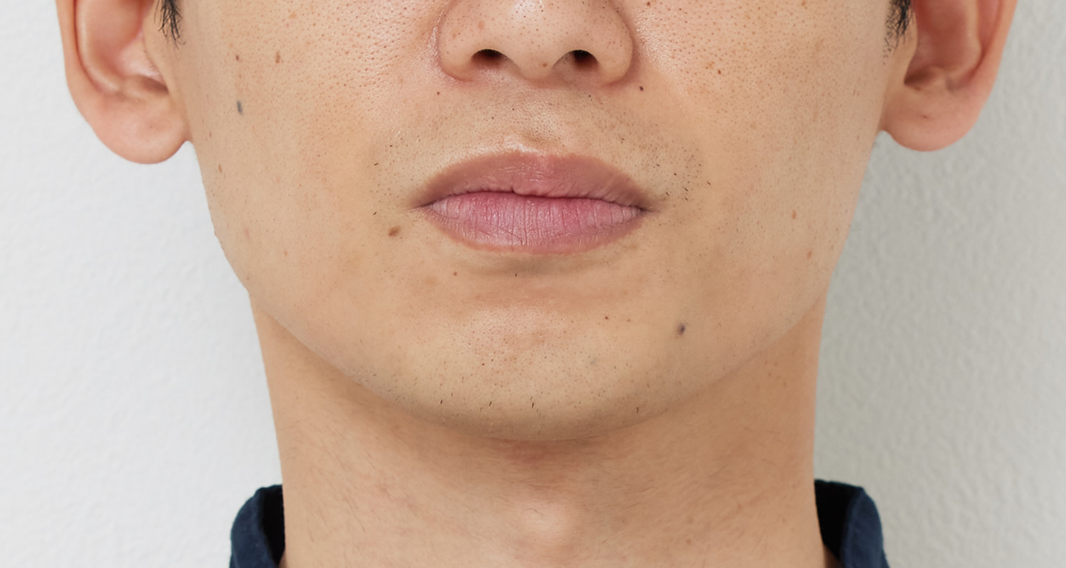 ヒゲ脱毛の症例写真 鼻下・あご 9回照射後