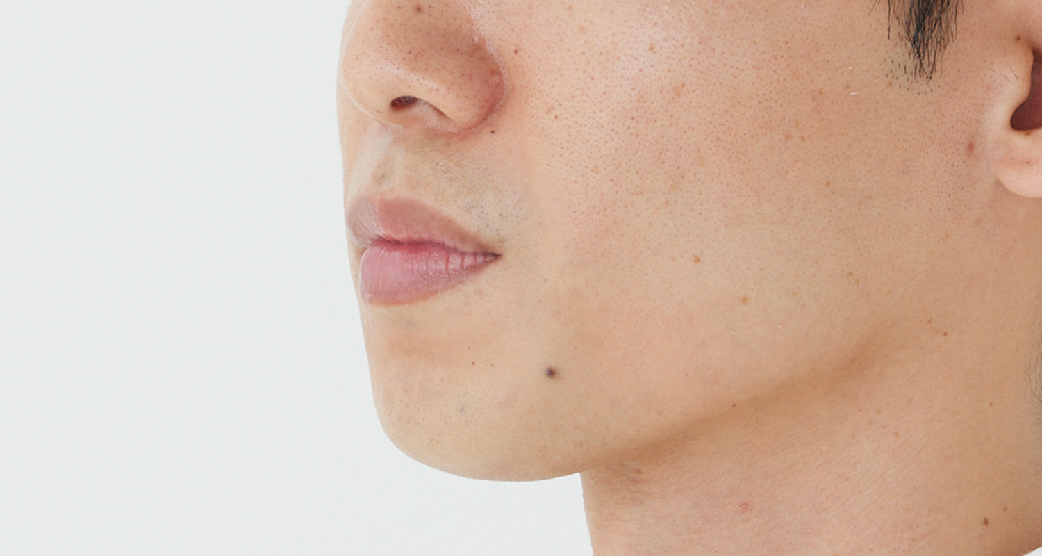 ヒゲ脱毛の症例写真 左頬 10回照射後