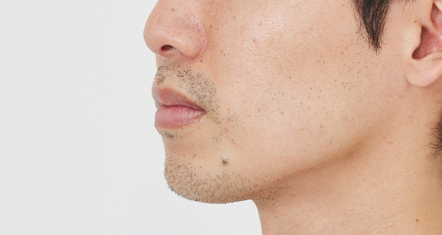 ヒゲ脱毛の症例写真 左頬 2回照射後