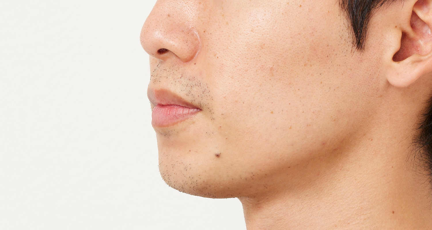 ヒゲ脱毛の症例写真 左頬 3回照射後