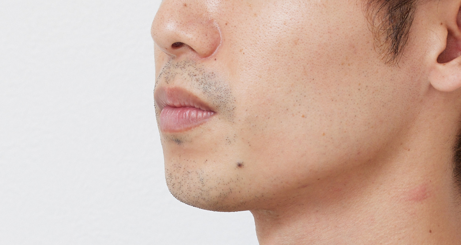 ヒゲ脱毛の症例写真 左頬 4回照射後