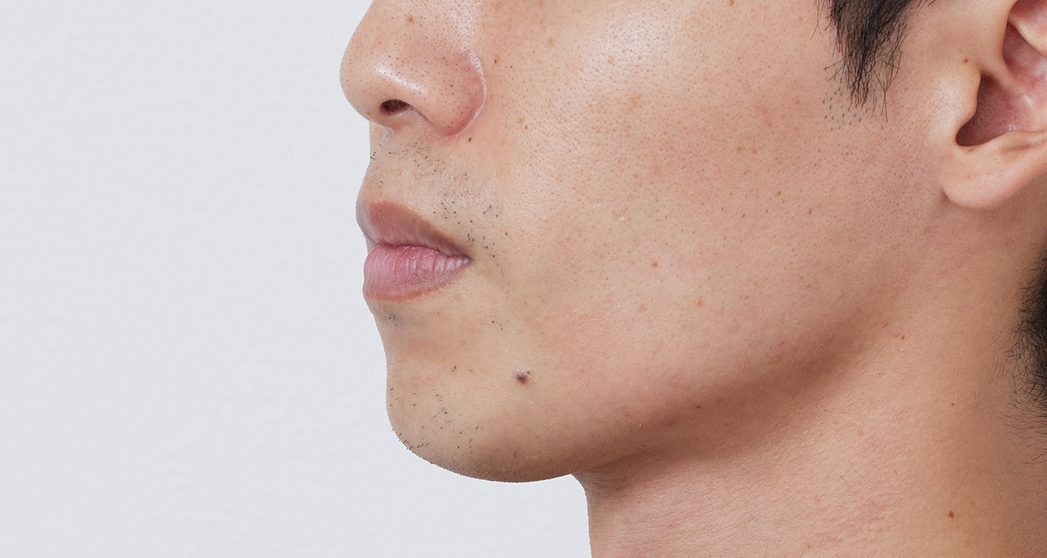 ヒゲ脱毛の症例写真 左頬 5回照射後