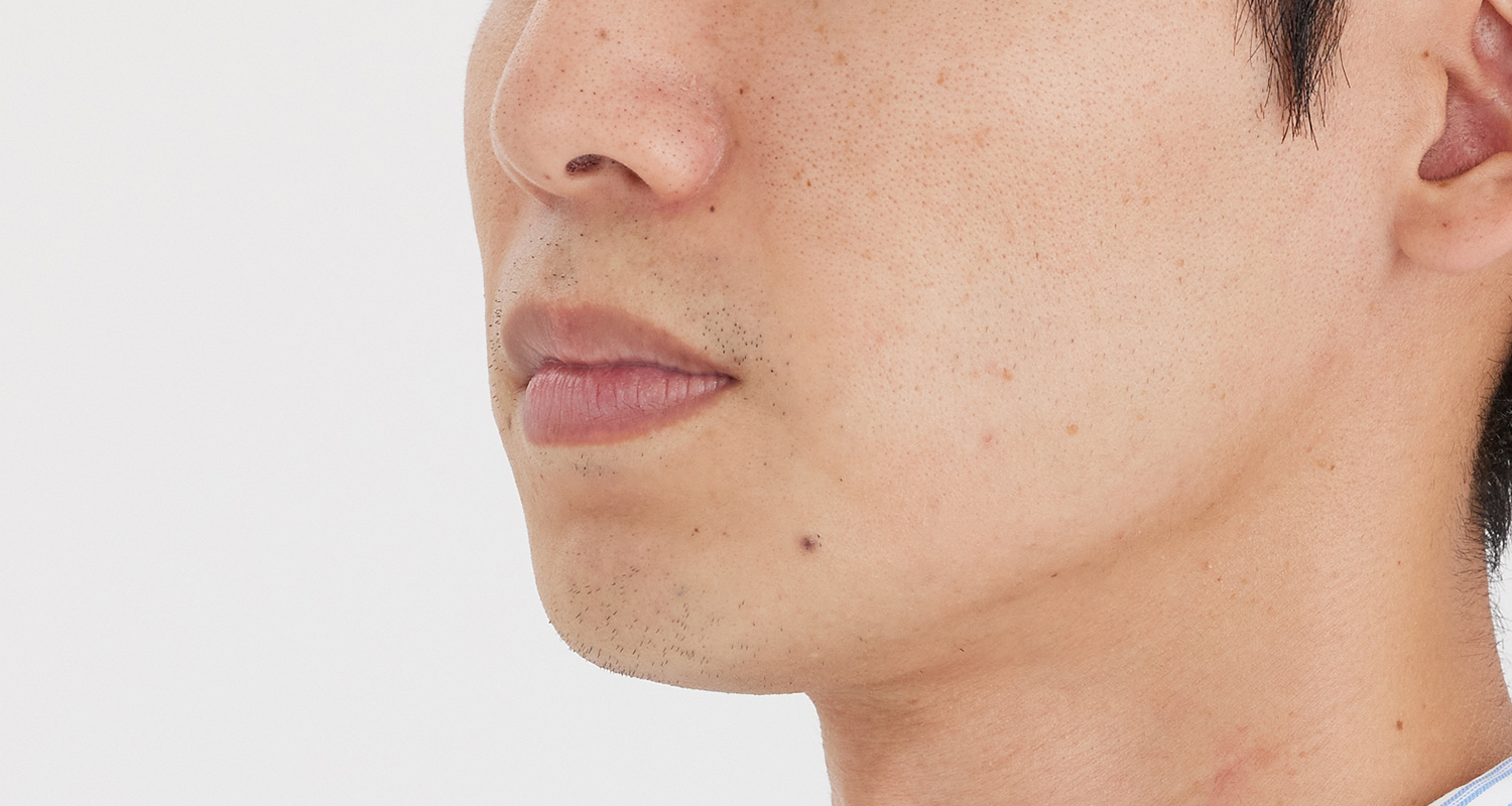 ヒゲ脱毛の症例写真 左頬 6回照射後