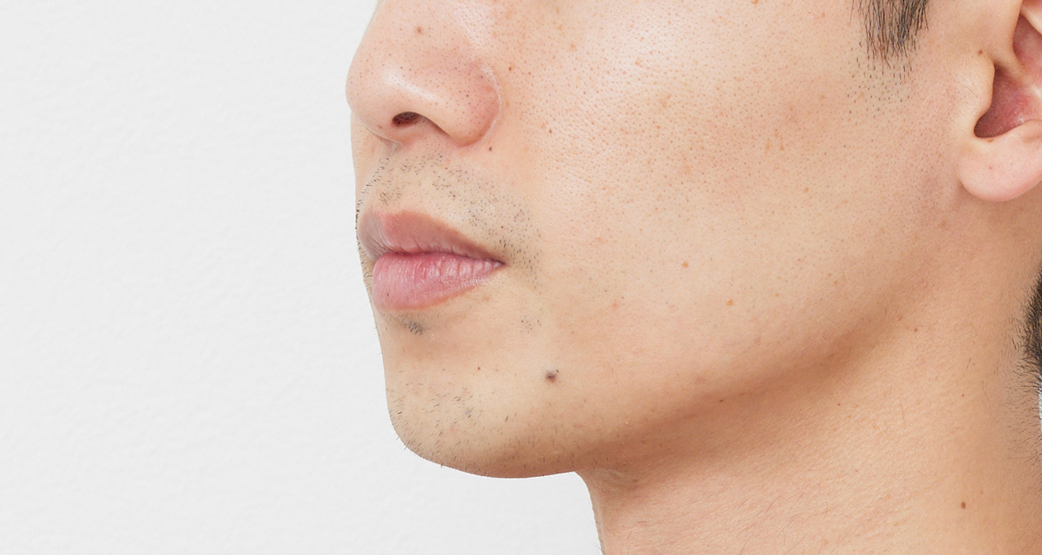 ヒゲ脱毛の症例写真 左頬 7回照射後