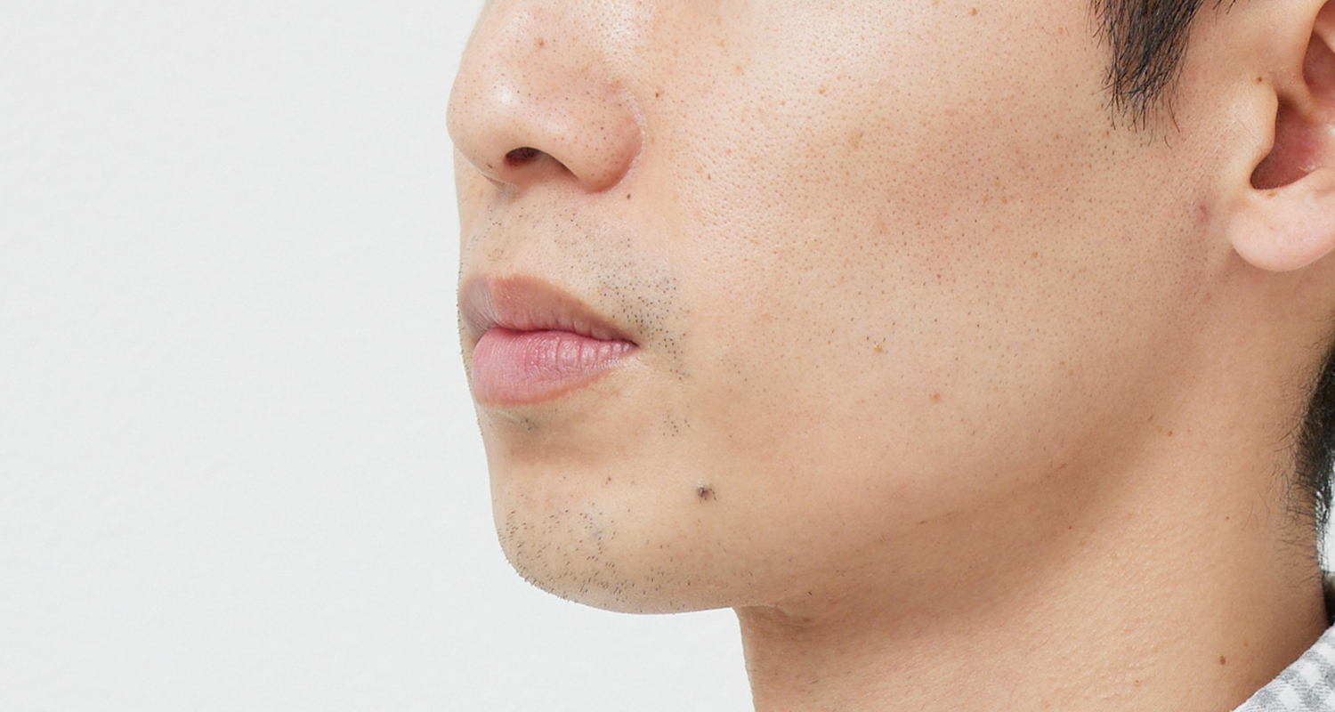 ヒゲ脱毛の症例写真 左頬 8回照射後