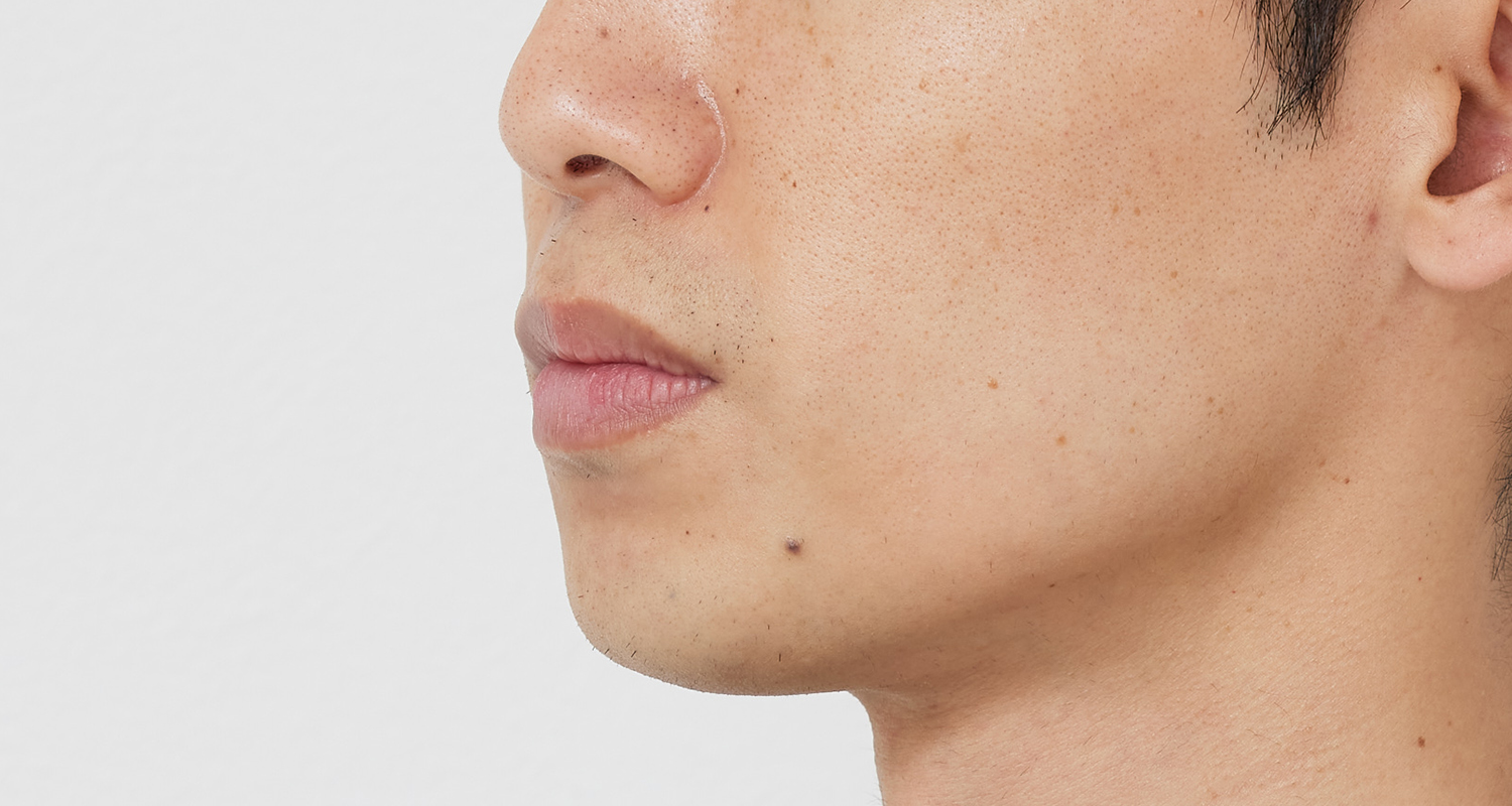 ヒゲ脱毛の症例写真 左頬 9回照射後