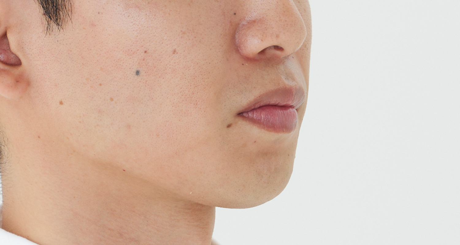 ヒゲ脱毛の症例写真 右頬 10回照射後