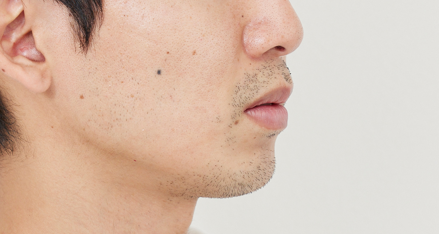 ヒゲ脱毛の症例写真 右頬 2回照射後