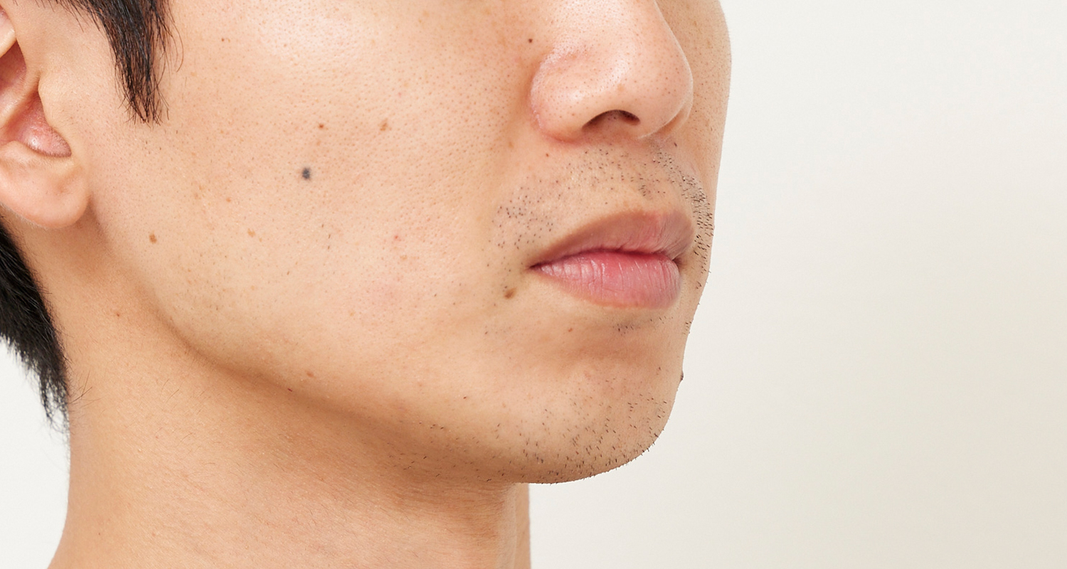 ヒゲ脱毛の症例写真 右頬 3回照射後