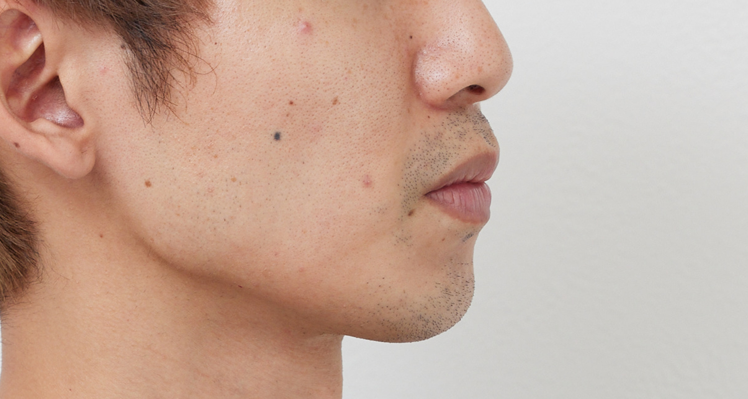 ヒゲ脱毛の症例写真 右頬 4回照射後