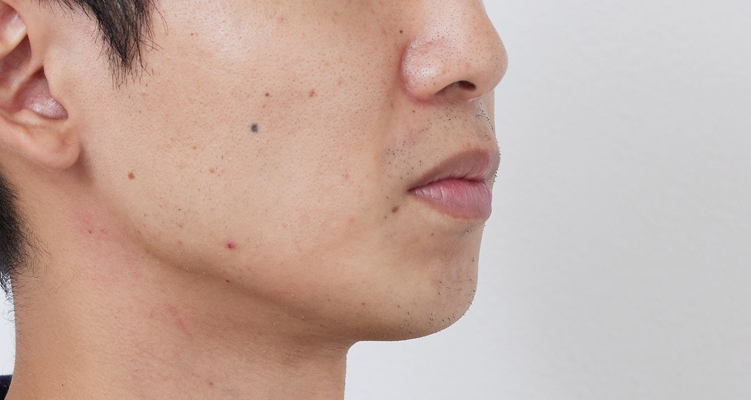 ヒゲ脱毛の症例写真 右頬 5回照射後