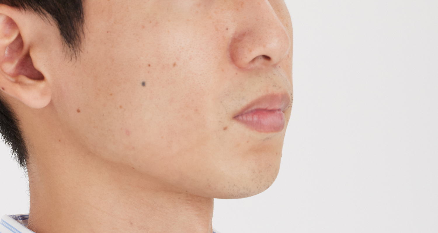 ヒゲ脱毛の症例写真 右頬 6回照射後