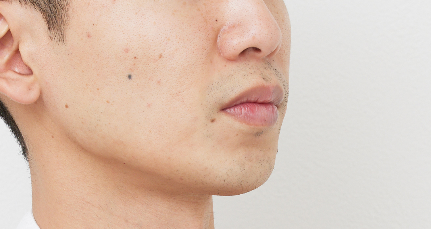 ヒゲ脱毛の症例写真 右頬 7回照射後