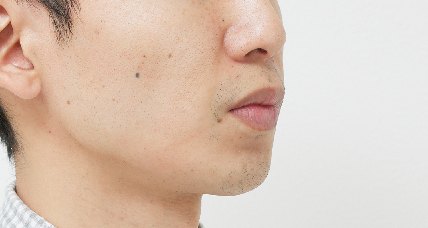 ヒゲ脱毛の症例写真 右頬 8回照射後