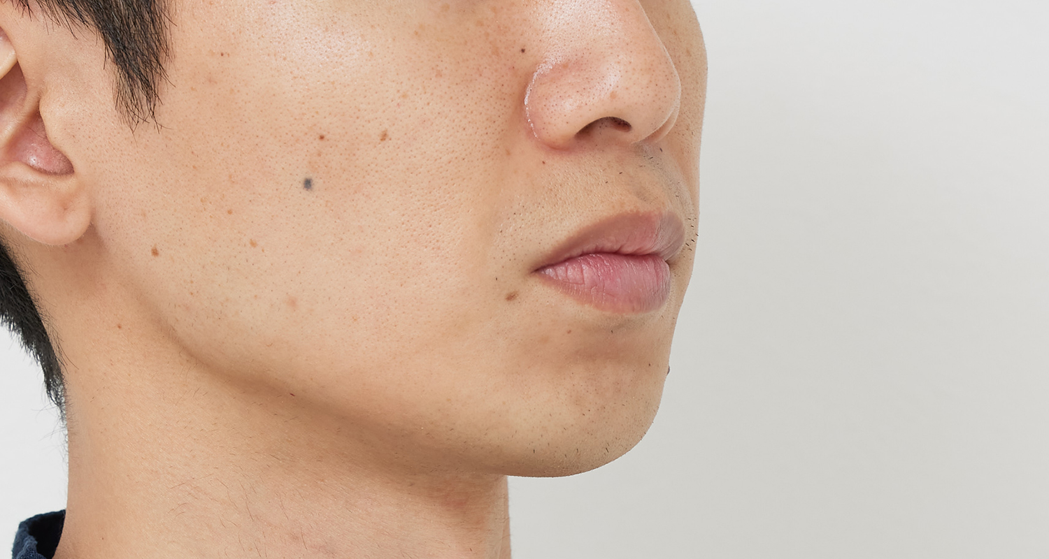 ヒゲ脱毛の症例写真 右頬 9回照射後