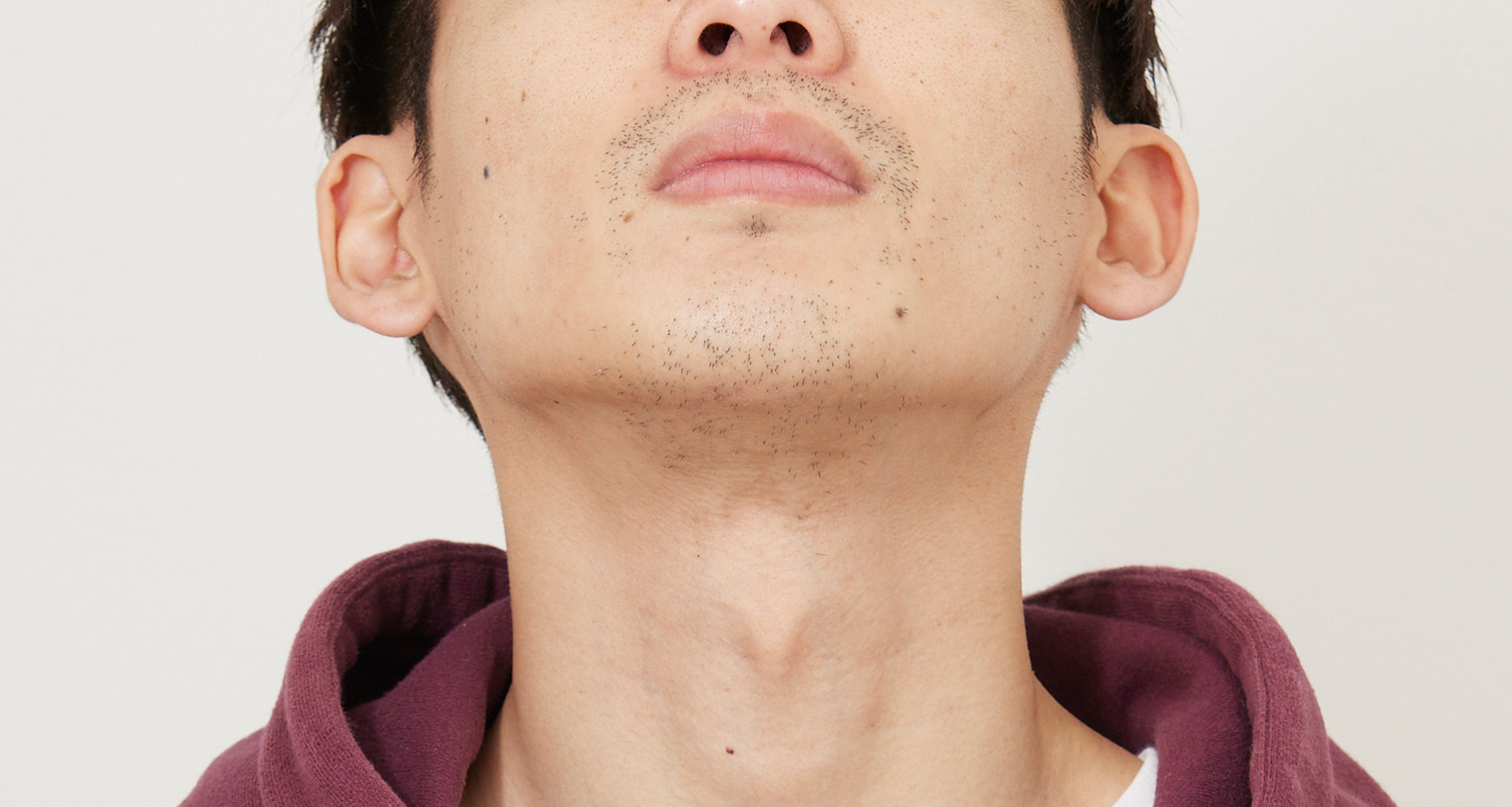 あご裏・首 AFTER