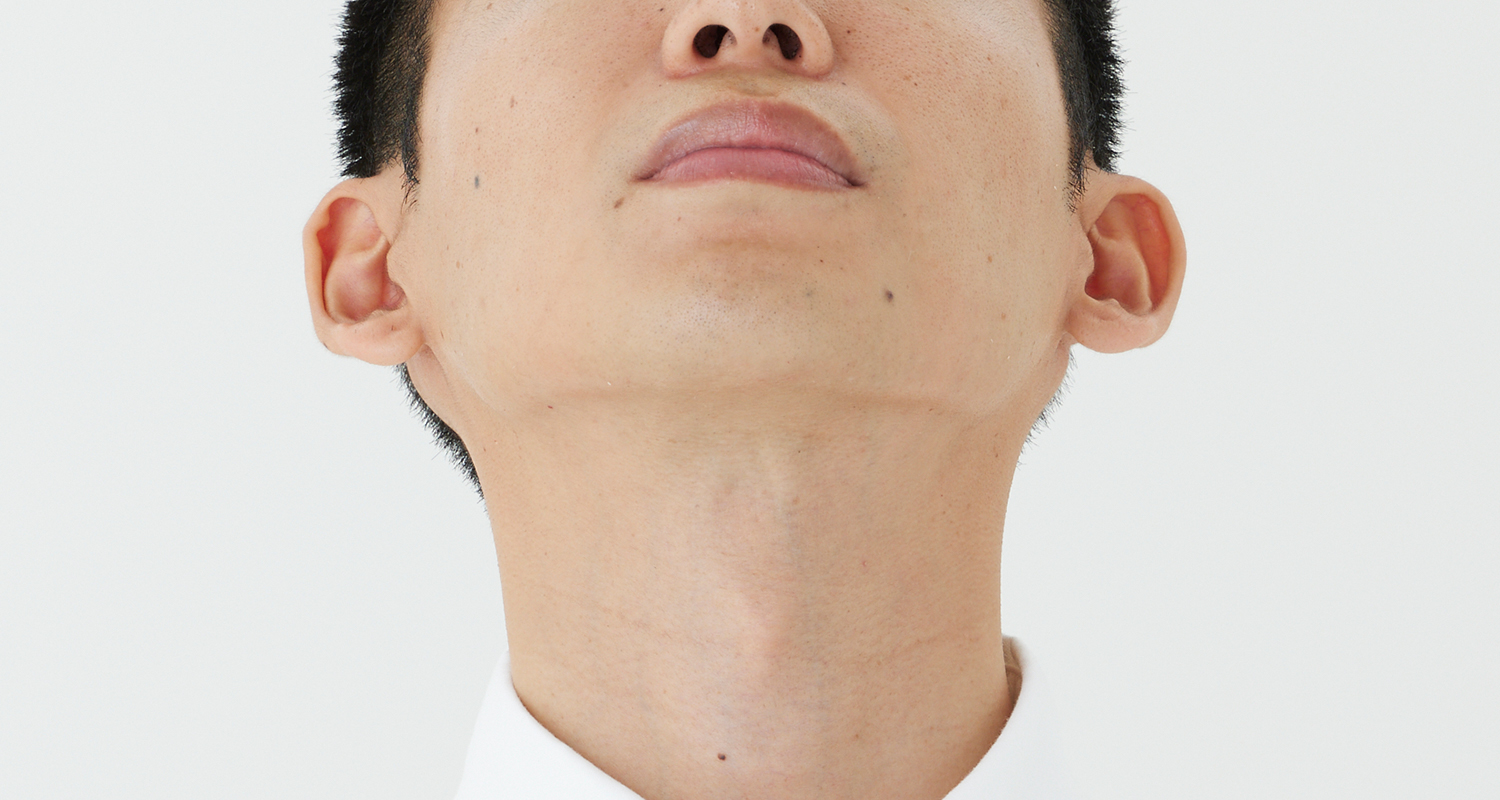 ヒゲ脱毛の症例写真 あご裏・首 10回照射後