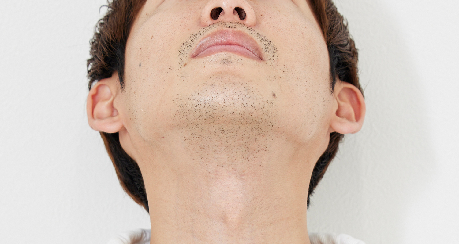 ヒゲ脱毛の症例写真 あご裏・首 2回照射後