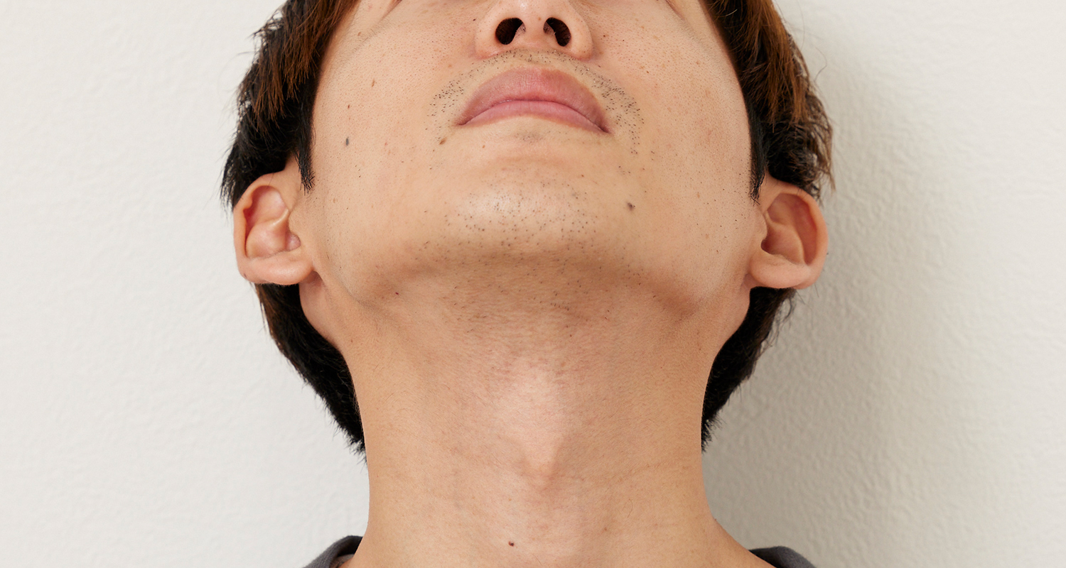 ヒゲ脱毛の症例写真 あご裏・首 3回照射後