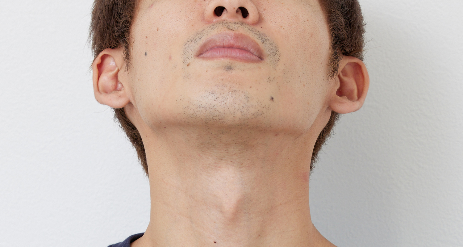 ヒゲ脱毛の症例写真 あご裏・首 4回照射後