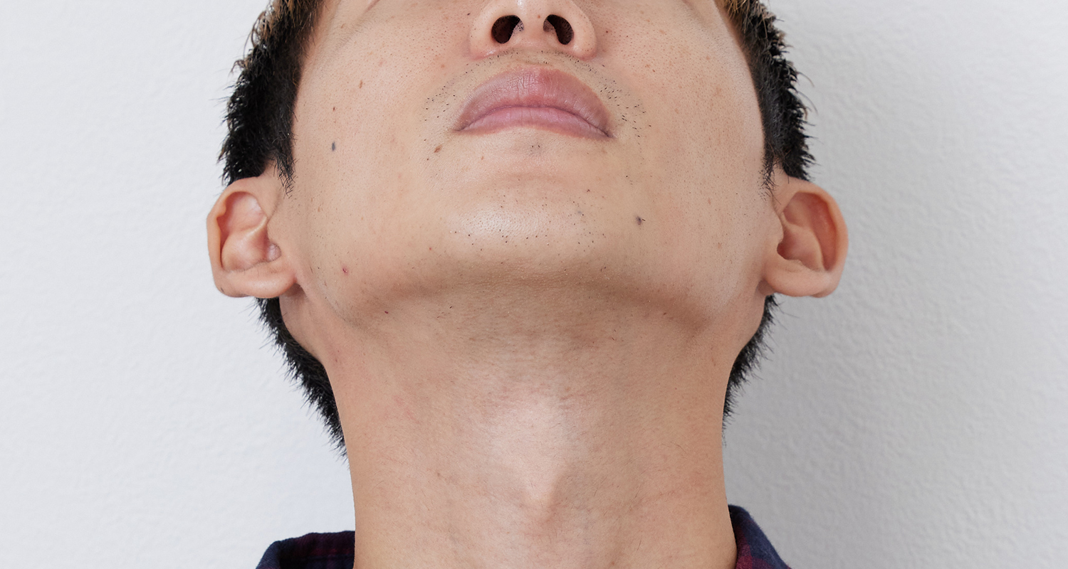 ヒゲ脱毛の症例写真 あご裏・首 5回照射後