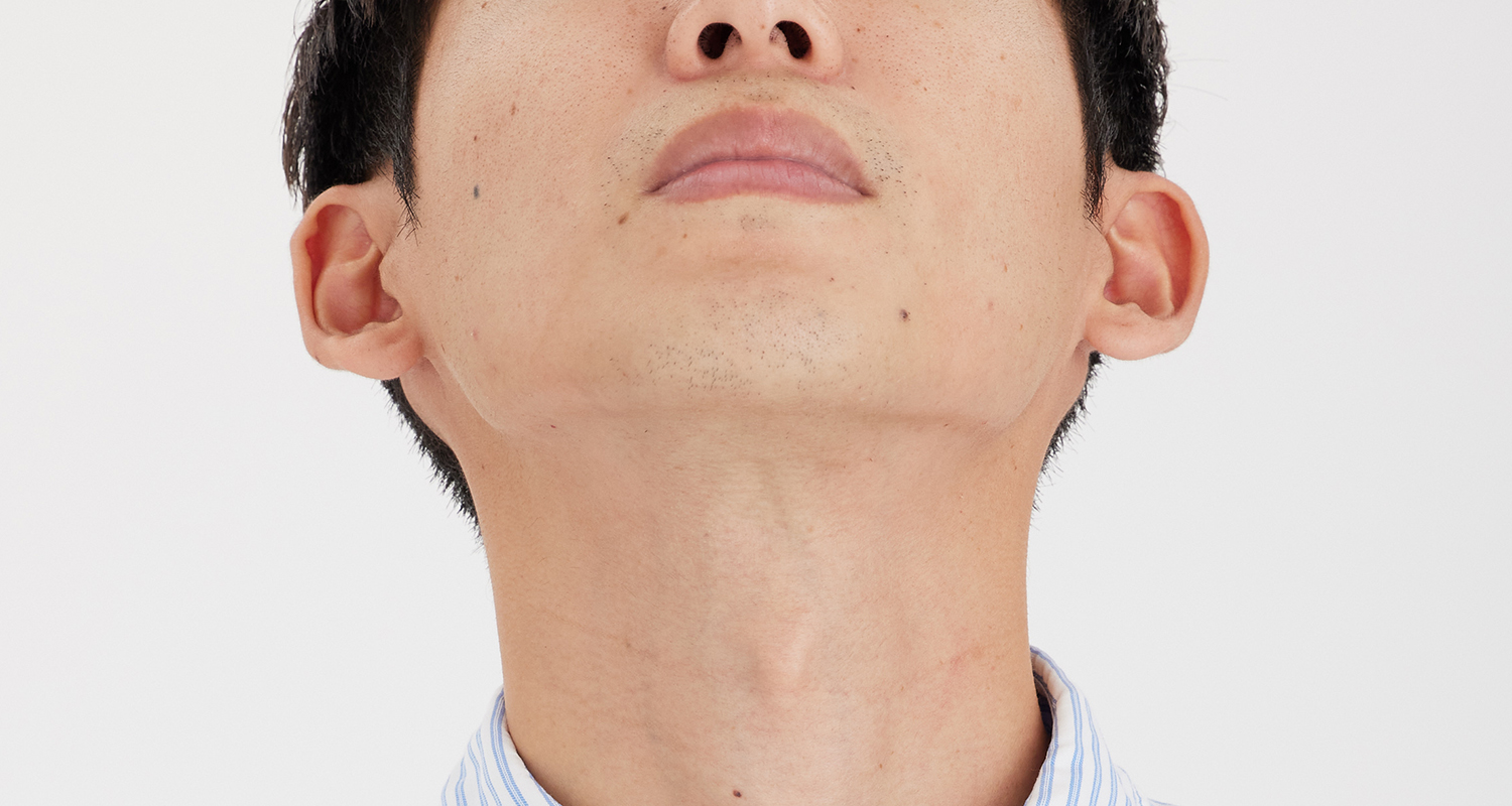 ヒゲ脱毛の症例写真 あご裏・首 6回照射後