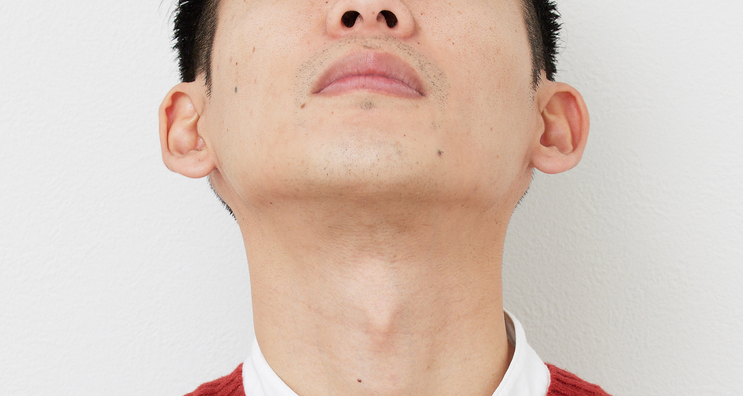 ヒゲ脱毛の症例写真 あご裏・首 7回照射後