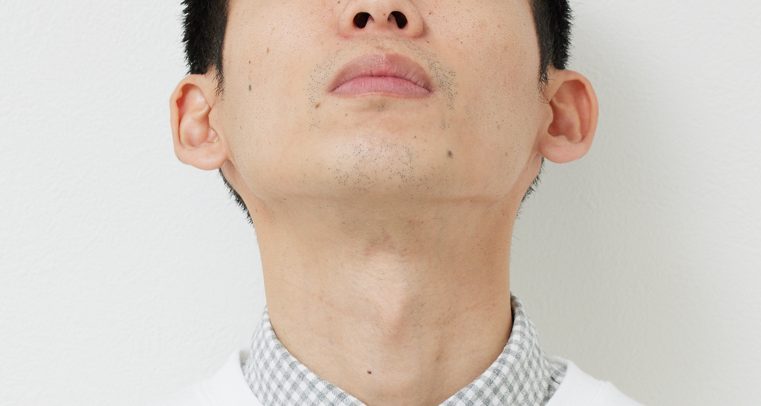 ヒゲ脱毛の症例写真 あご裏・首 8回照射後