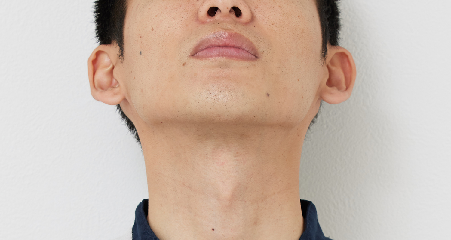 ヒゲ脱毛の症例写真 あご裏・首 9回照射後