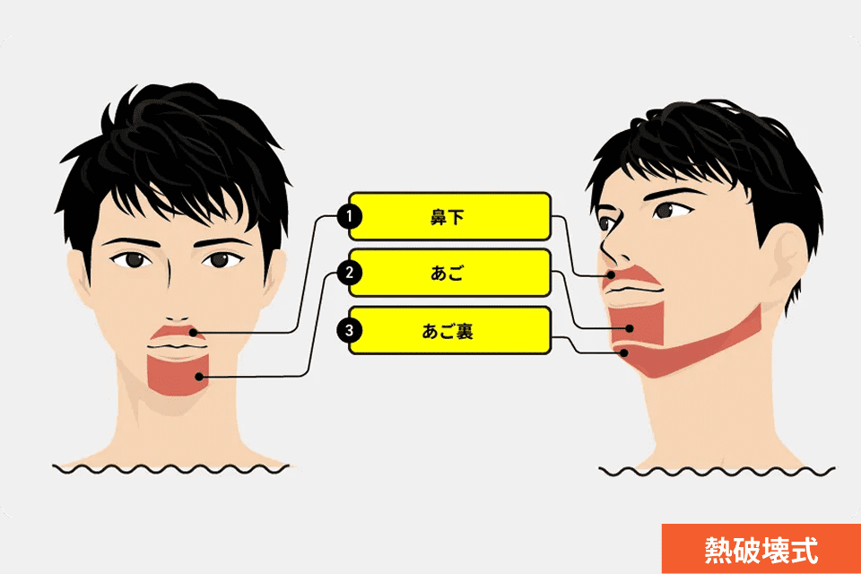 ヒゲ脱毛（3部位）の照射範囲