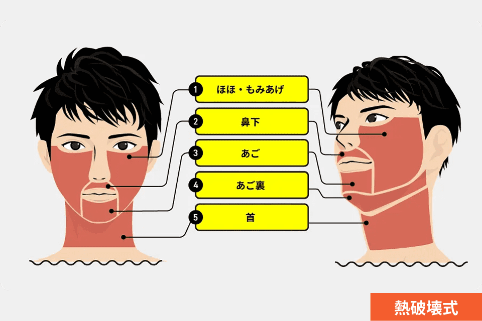 ヒゲ脱毛（全部位）の照射範囲