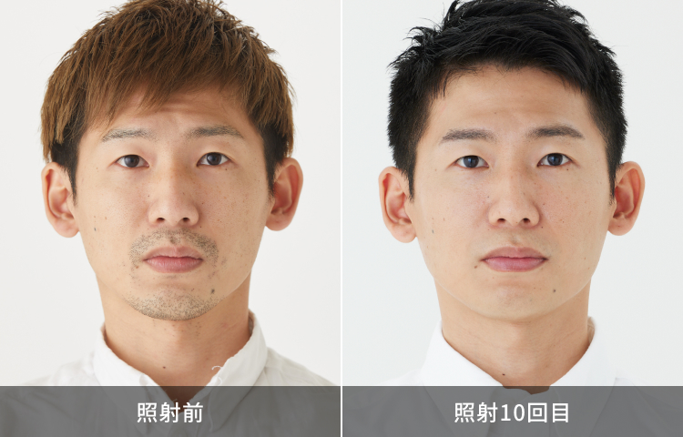 ヒゲ脱毛症例写真before after