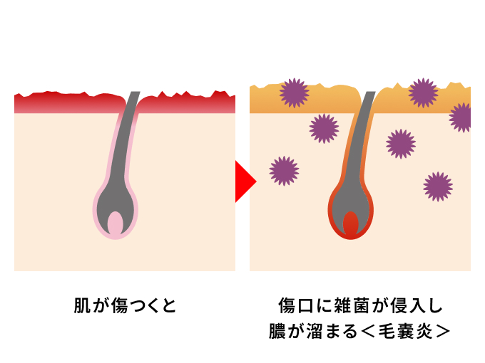 傷ついた肌に細菌が入り炎症が起きる