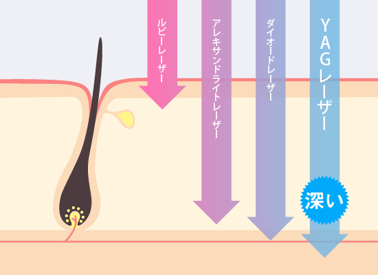 脱毛機の波長