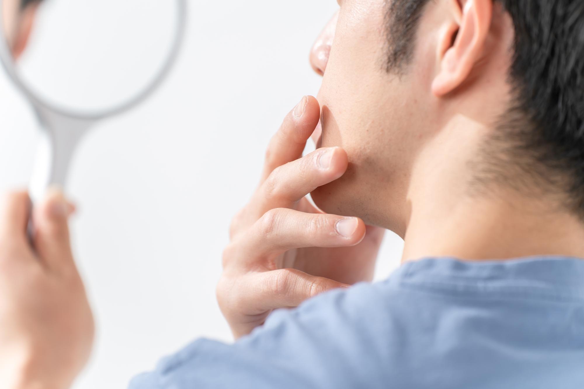 頬のヒゲが増えたり濃くなったりする