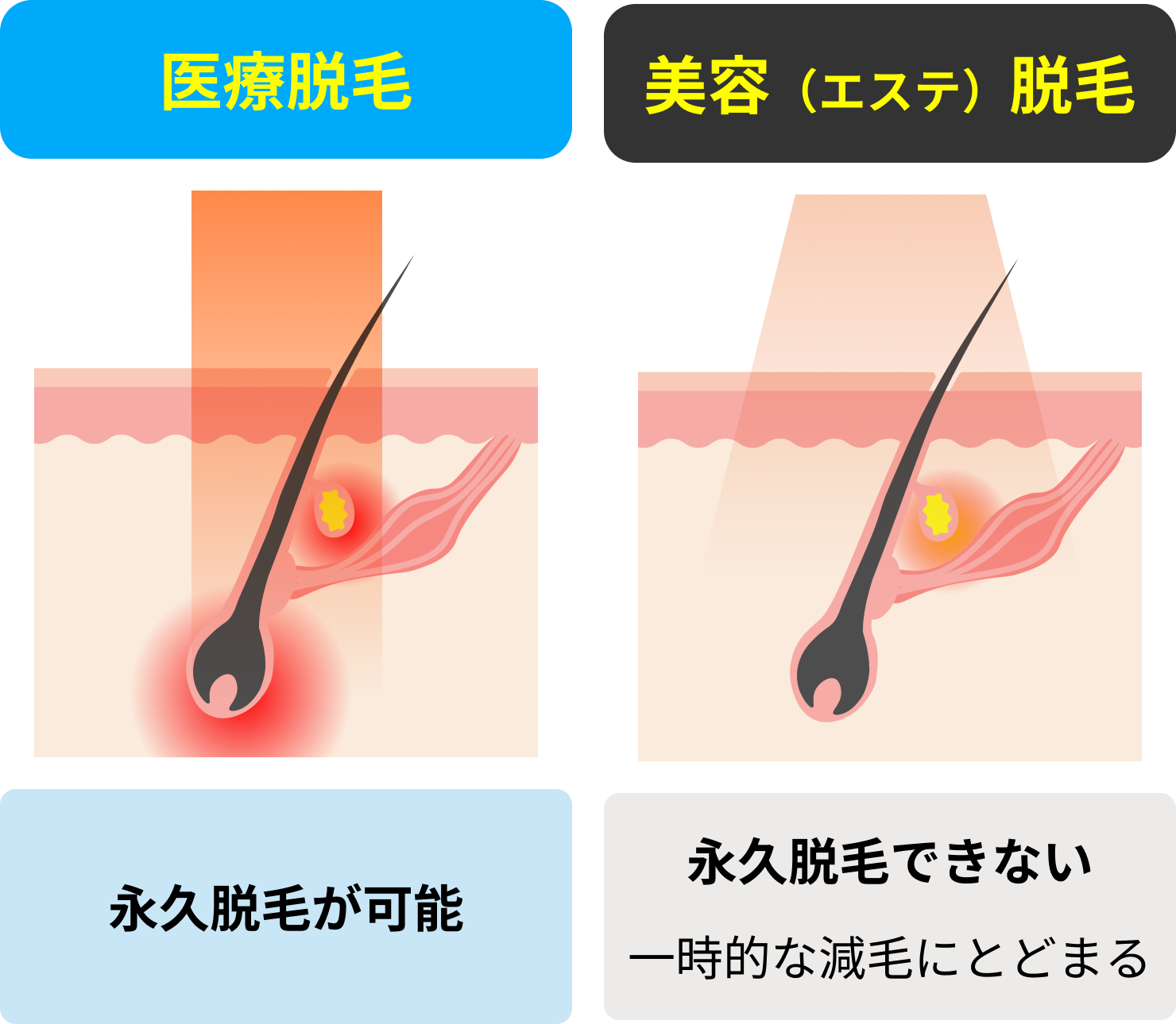 医療脱毛は永久脱毛が可能、美容脱毛は永久脱毛できない