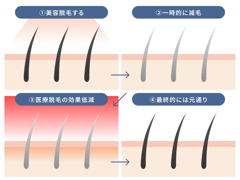 美容脱毛してから医療脱毛しても意味がない