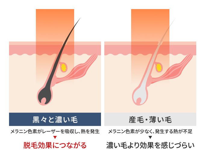 産毛など、色素が薄い毛には反応しにくい場合がある